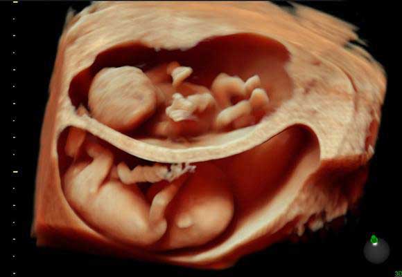 HDlive ultrasound płodu – szczegółowy obraz rąk i nóg dziecka w macicy
