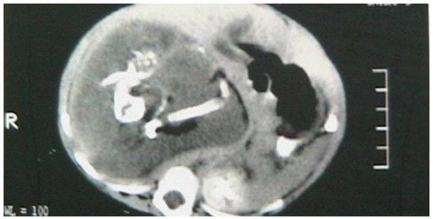 noworodek-w-ciazy-i-to-blizniaczej